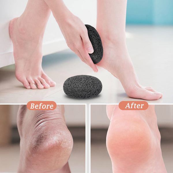 2 Pcs Maryton Natural Volcanic Lava Pumice Foot Stone, Callus Remover for Skin Exfoliation